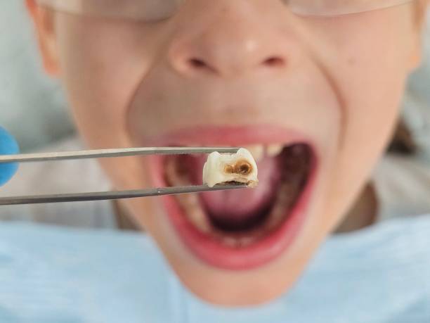 Best Emergency Dental Extractions in Waterford, CA